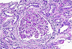 Mystery NEPHROLOGY CPC