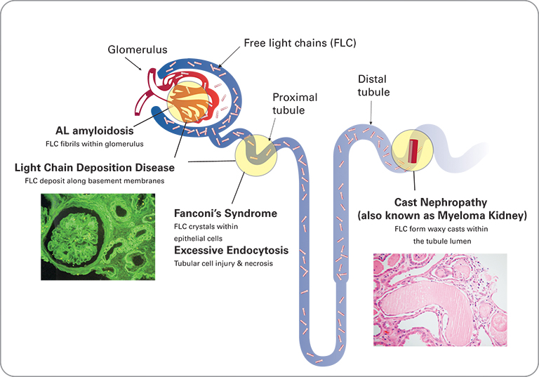 – Myeloma Cast Nephropathy