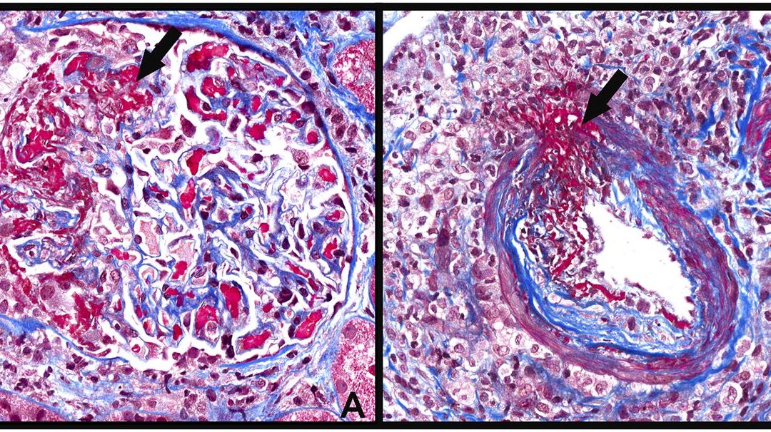 A Case Based Discussion: ANCA Related GN  Glomerular Disease Study & Trial Consortium