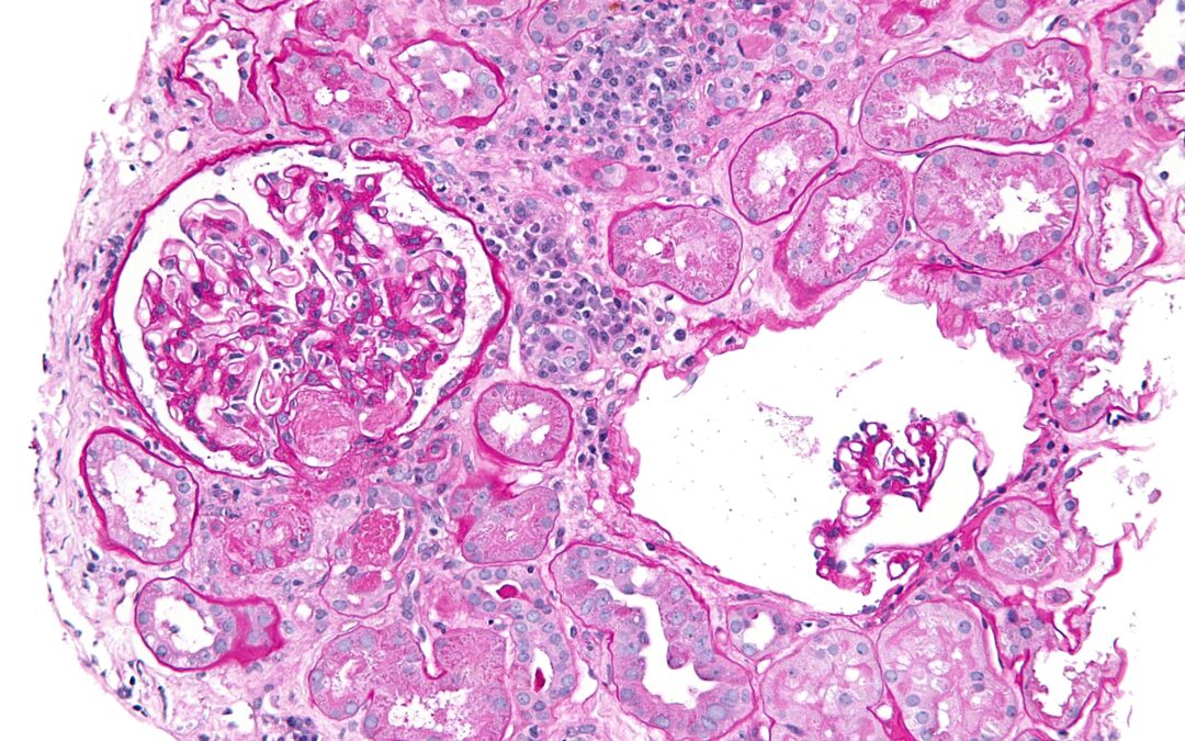 A Case Based Discussion: Thrombotic Microangiopathy