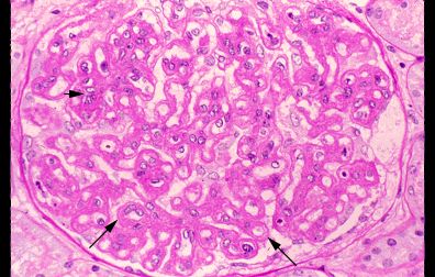 MPGN Pattern of Injury