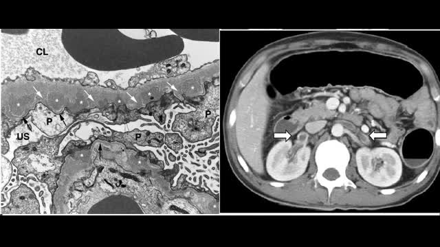 48-year-old man presents with acute onset right flank pain and nephrotic syndrome