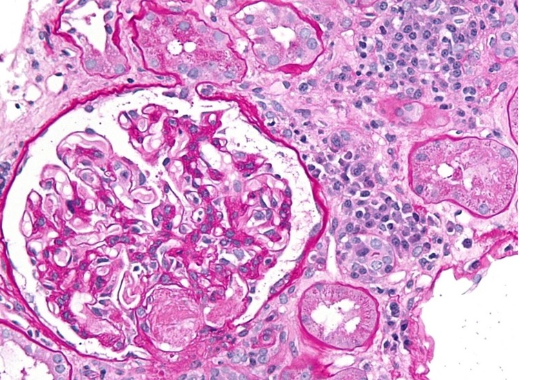 77-year-old man with a type 2 DM presents with worsening renal function and proteinuria