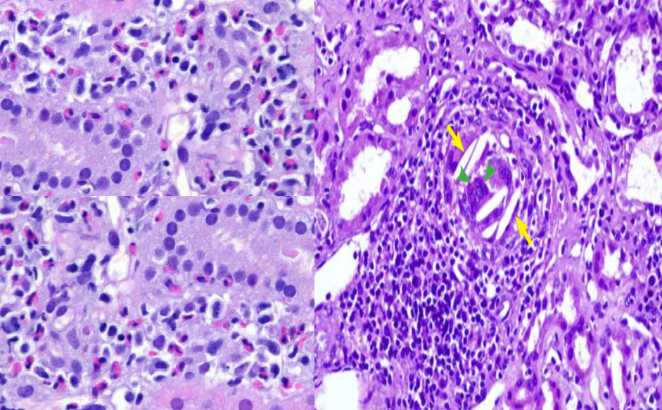 77-year-old male with HTN & recent TIA has AKI & hyperkalemia