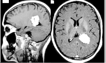 78-year-old male with metastatic myeloma with AMS, polyuria & neutropenic fever.