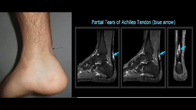 Achilles tendon rupture in a 37 year old HD patient