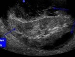 Transplant patient with AKI & Kidney stone