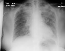 Hyponatremia – chest tightness, SOB, productive cough.