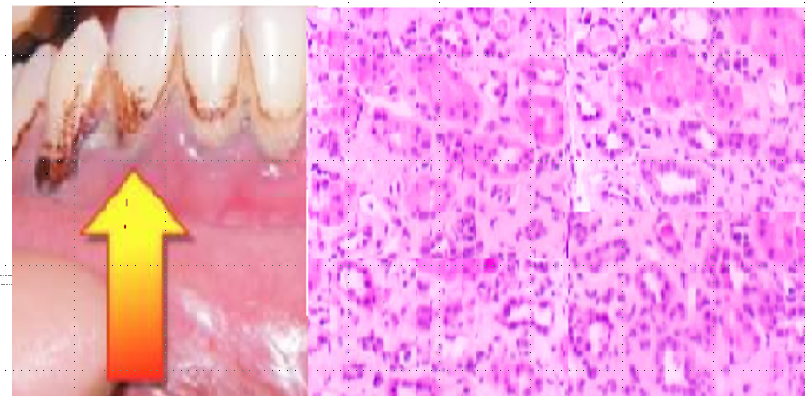 55-year-old male with post renal transplant with worsening renal function, HTN and gout attacks.