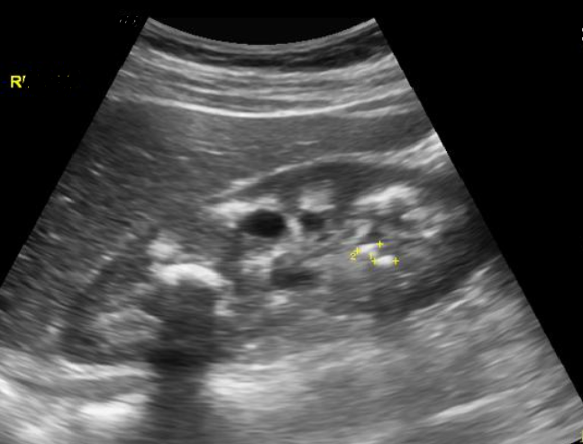 25 year old lady with severe weakness, hypokalemia, metabolic acidosis and kidney stones.