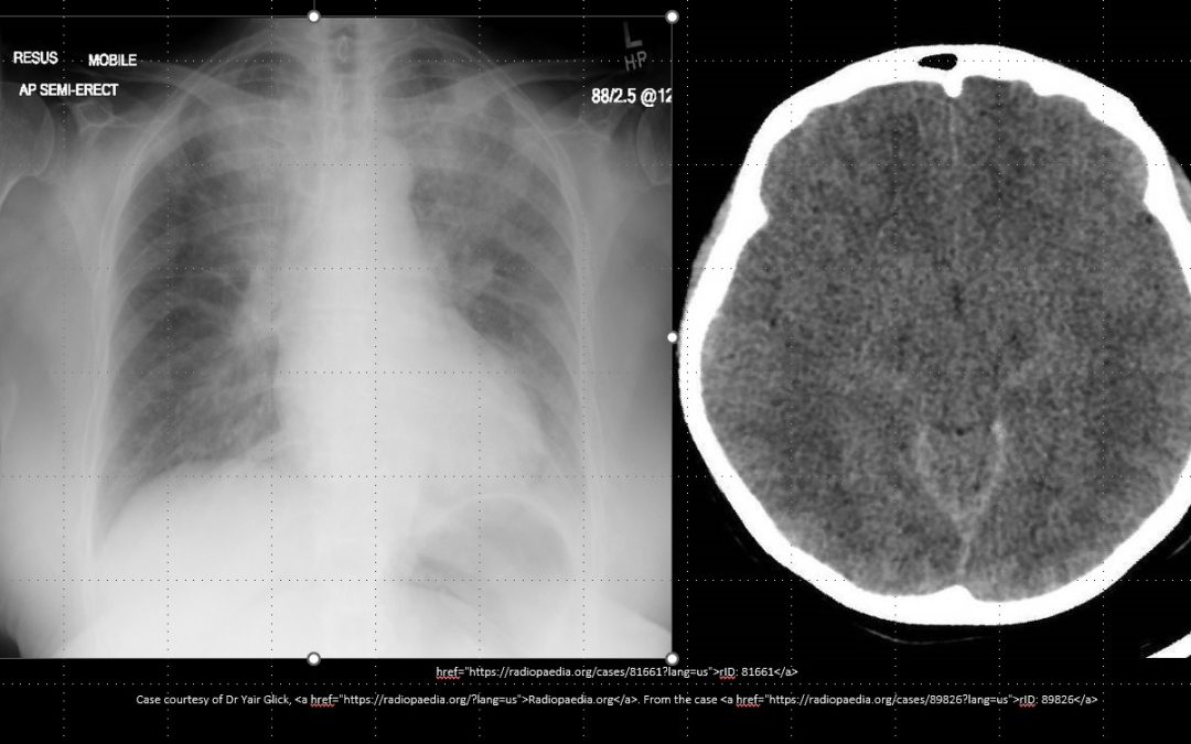 55-year-old lady with ASA poisoning, dyspnea and altered mental status.