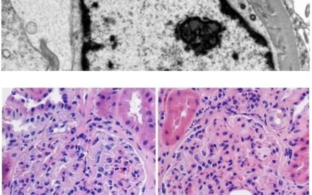 22 year old lady with muscle weakness, renal insufficiency and  proteinuria