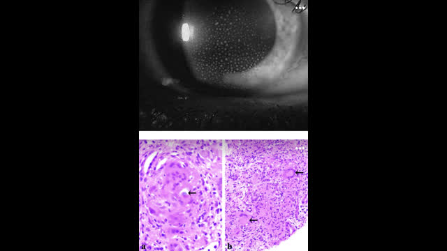 45-year-old male with eye pain, blurred vision, renal insufficiency and proteinuria.